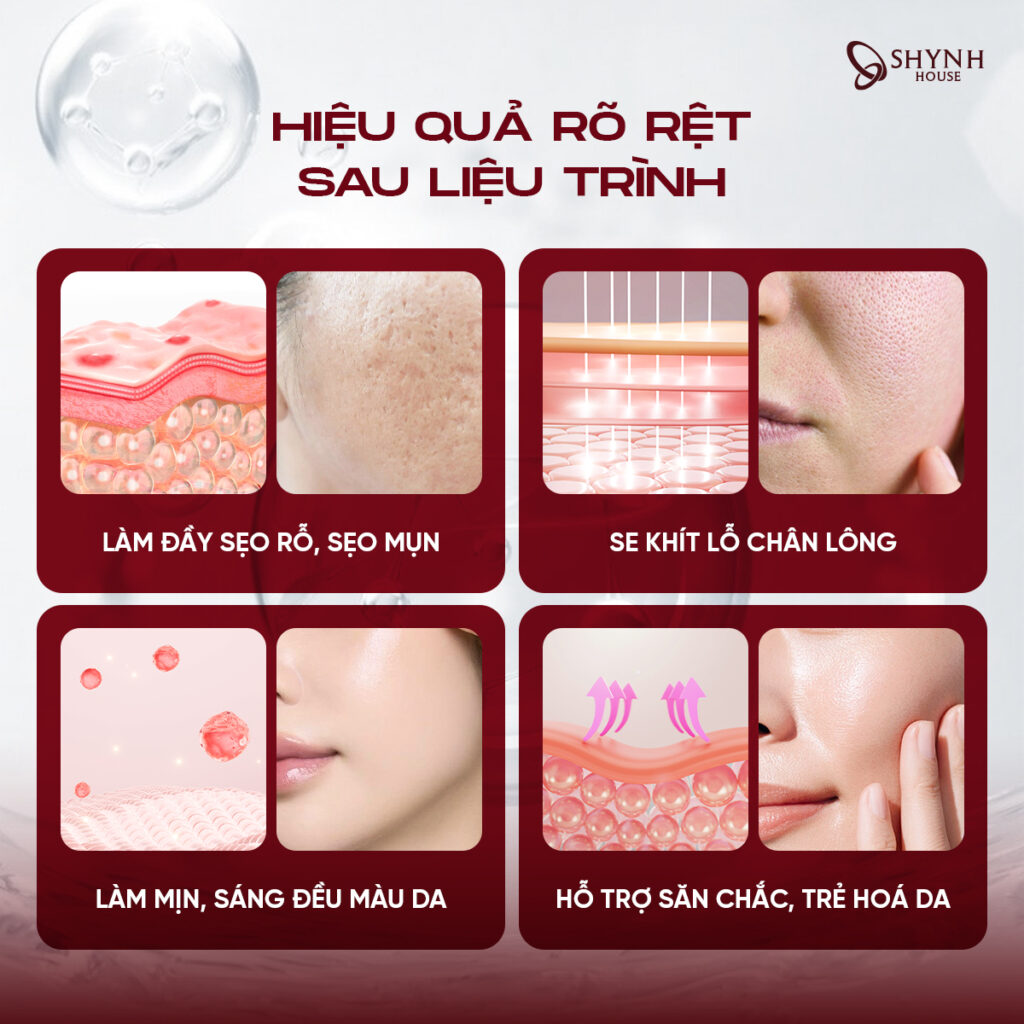 Liệu trình xGen 4.0 kết hợp nhiều công nghệ giúp hỗ trợ cải thiện sẹo rỗ và tái tạo bề mặt da