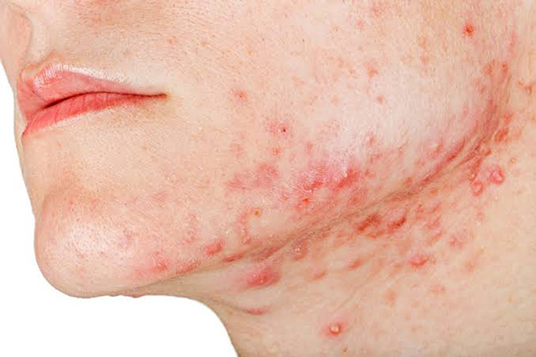 Mụn vùng hàm dưới thường liên quan đến nội tiết tố và tình trạng da bị bít tắc