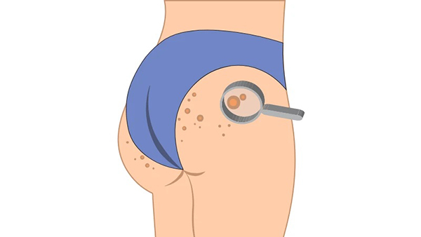 Mụn mọc ở vùng mông và vùng kín do ma sát, mồ hôi và viêm nang lông