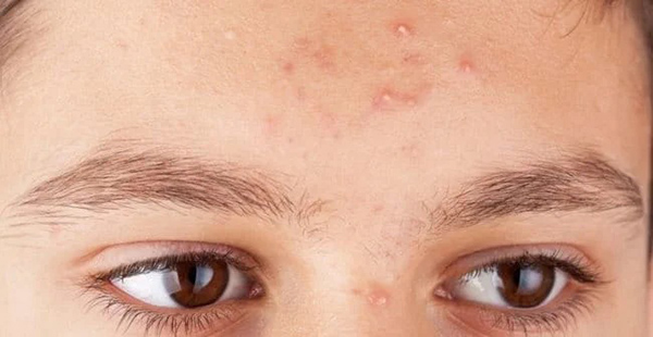 Dầu thừa, tóc mái, sản phẩm chăm sóc tóc và thói quen sinh hoạt gây mụn ở trán