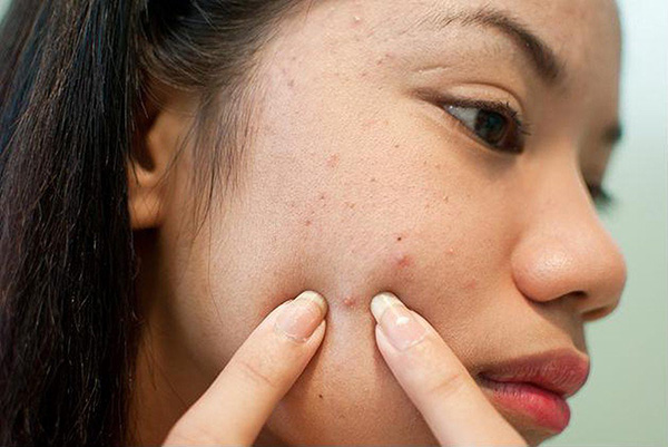 Các vị trí mọc mụn trên mặt cần chú ý khi mụn tái phát kéo dài