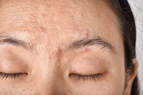 Vị trí mọc mụn giữa hai đầu lông mày do dầu thừa và bít tắc lỗ chân lông