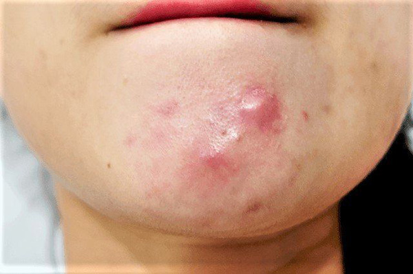 Mụn ở cằm là vị trí mọc mụn trên mặt phổ biến liên quan đến nội tiết tố