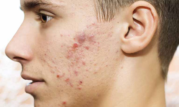 Vị trí mọc mụn ở gò má phải do bít tắc lỗ chân lông và bụi bẩn