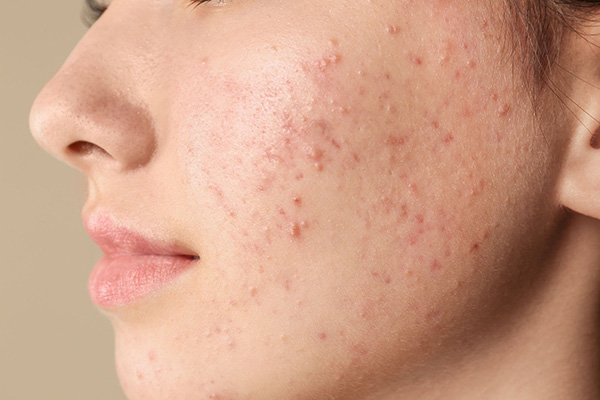 Mụn ở má phải liên quan đến vệ sinh da, khẩu trang, điện thoại…