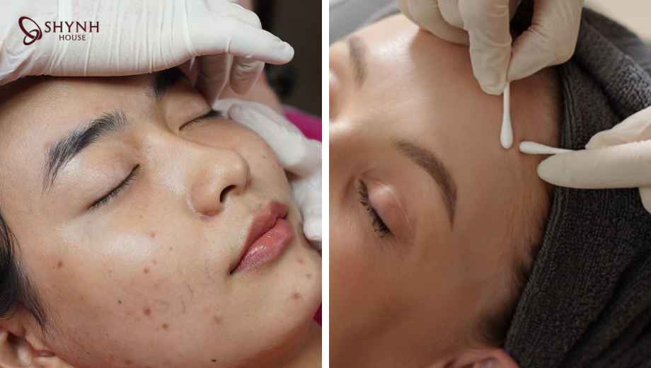 Trị mụn chuẩn y khoa bằng tay hoặc tăm bông