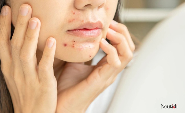 Các bước cách trị mụn viêm tại nhà gồm làm sạch da, sử dụng hoạt chất đặc trị và chống nắng đúng cách