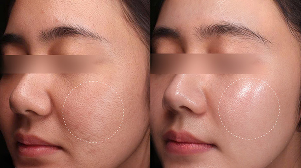 Soi da và tư vấn lựa chọn công nghệ trị nám phù hợp theo từng tình trạng sắc tố