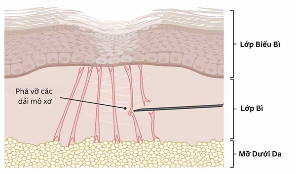 Điều trị sẹo rỗ bằng laser đau hay không phụ thuộc vào nhiều yếu tố