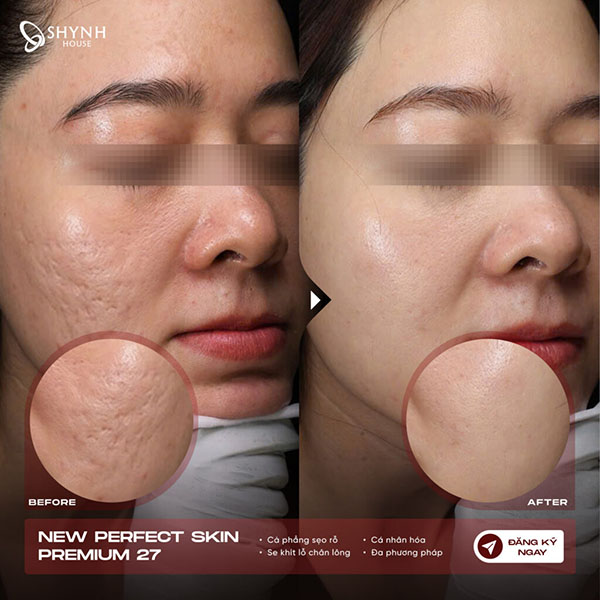 Thực hiện kỹ thuật cắt đáy sẹo giúp giải phóng mô xơ dưới da