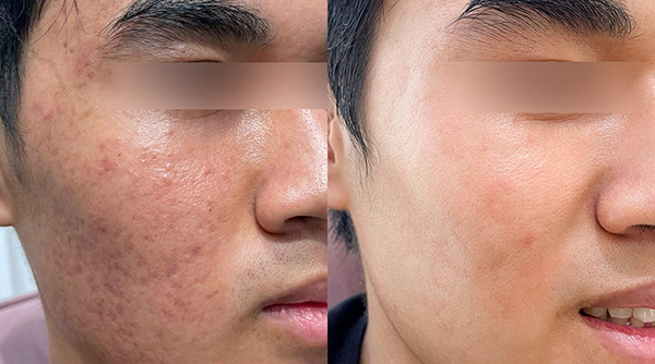 Điều chỉnh thông số laser phù hợp với tình trạng da khách hàng