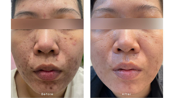 Hướng dẫn chăm sóc và phục hồi da sau liệu trình laser trị sẹo rỗ