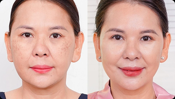 Khả năng cải thiện nám ở mỗi người sẽ khác nhau