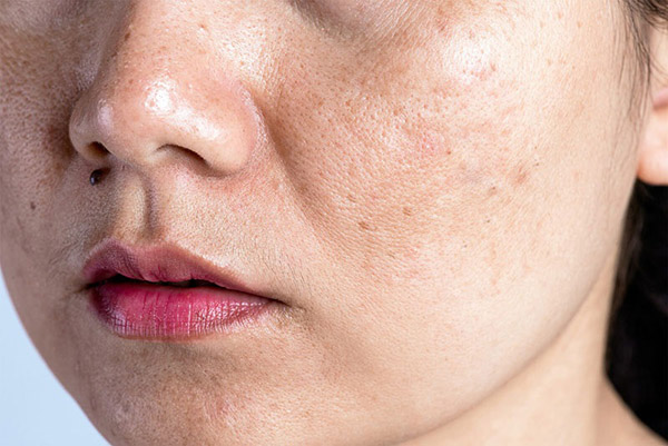 Tia UV, mỹ phẩm không phù hợp và môi trường ô nhiễm là những nguyên nhân ngoại sinh gây nám da