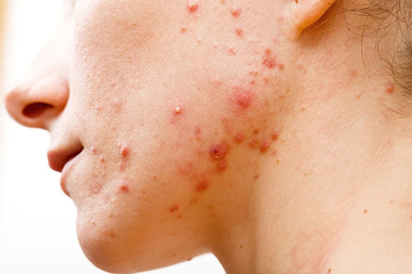Các nguyên nhân gây mụn phổ biến như vi khuẩn C. acnes, nội tiết, tăng tiết bã nhờn…