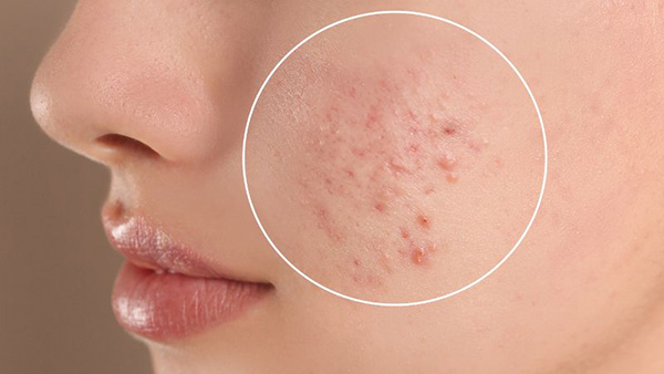 Các giai đoạn phát triển của mụn từ hình thành, viêm đến phục hồi và tái tạo da