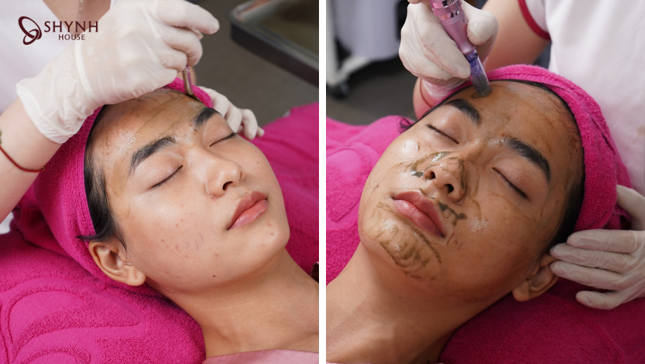 trị mụn thâm diệp lục