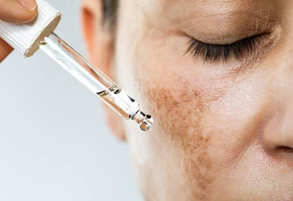 Tia UV và thay đổi nội tiết là những nguyên nhân phổ biến khiến nám da tái phát sau điều trị