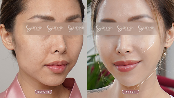 Khách hàng được soi da và xây dựng phác đồ laser trị nám cá nhân hóa tại Shynh House