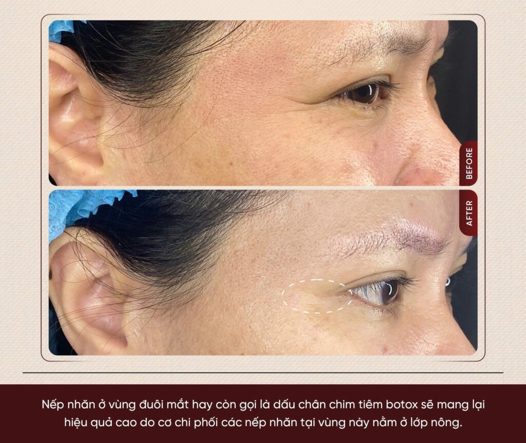 Hình ảnh trước và sau Cấy Baby Tox tại Shynh Medical Clinic