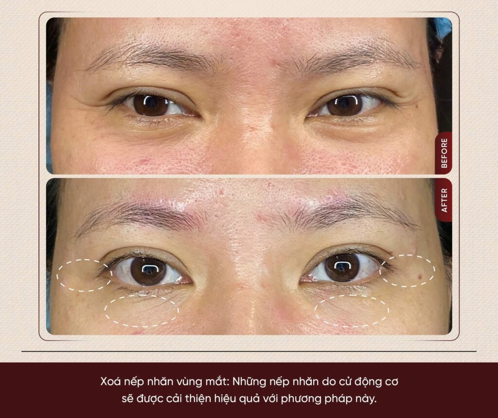Hình ảnh trước và sau Cấy Baby Tox tại Shynh Medical Clinic