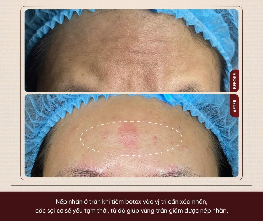 Hình ảnh trước và sau Cấy Baby Tox tại Shynh Medical Clinic