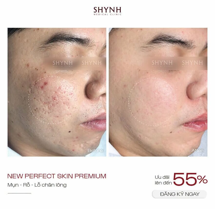 Hình ảnh before - after liệu trình New Perfect Skin Premium tại Shynh Medical Clinic