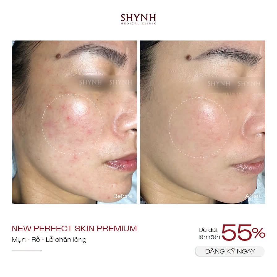 Hình ảnh before - liệu trình New Perfect Skin Premium tại Shynh Medical Clinic