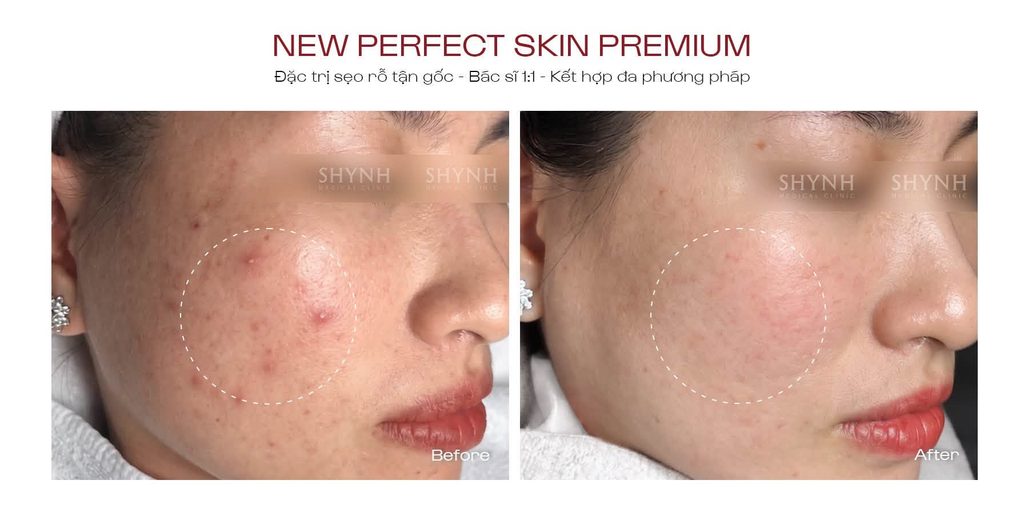 Hình ảnh before - liệu trình New Perfect Skin Premium tại Shynh Medical Clinic