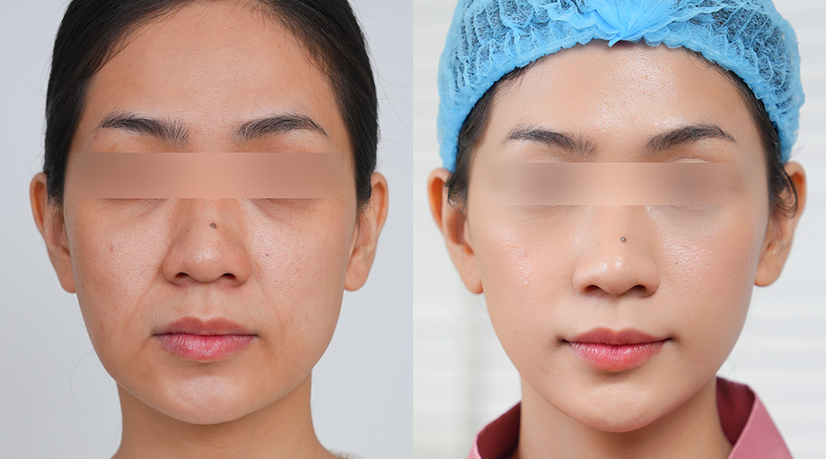 Hỗ trợ cải thiện đường nét gương mặt