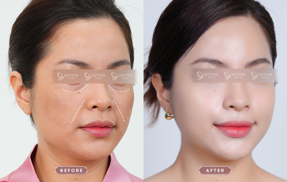GeneoX Skin Booster phù hợp để tham khảo khi bạn đang có nhu cầu chăm sóc chuyên sâu cho làn da