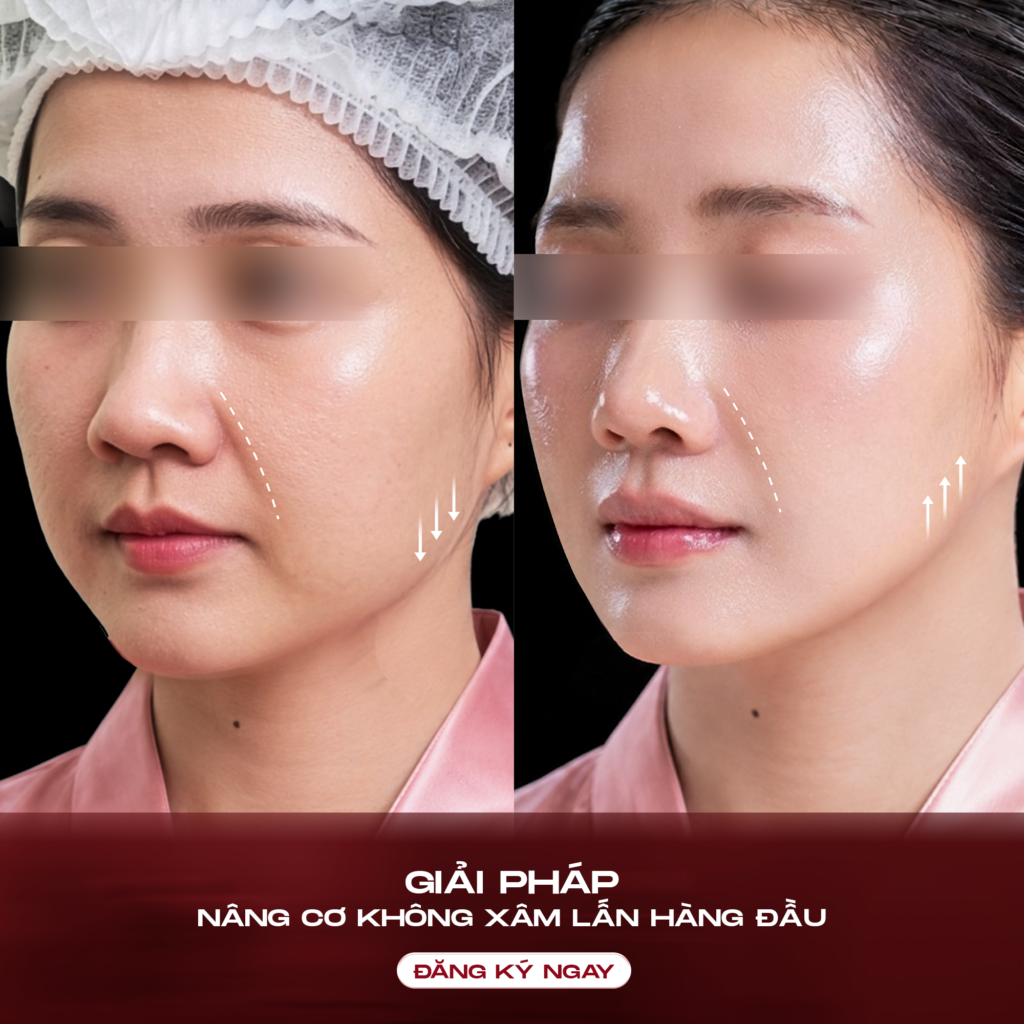 Hiệu quả nâng cơ có thể nhận thấy ngay sau khi thực hiện và tiếp tục cải thiện trong vòng 8 – 12 tuần nhờ quá trình tăng sinh collagen