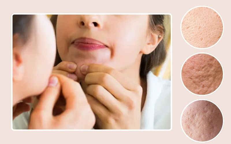 Không nặn mụn có bị rỗ không là thắc mắc của nhiều người khi bị mụn