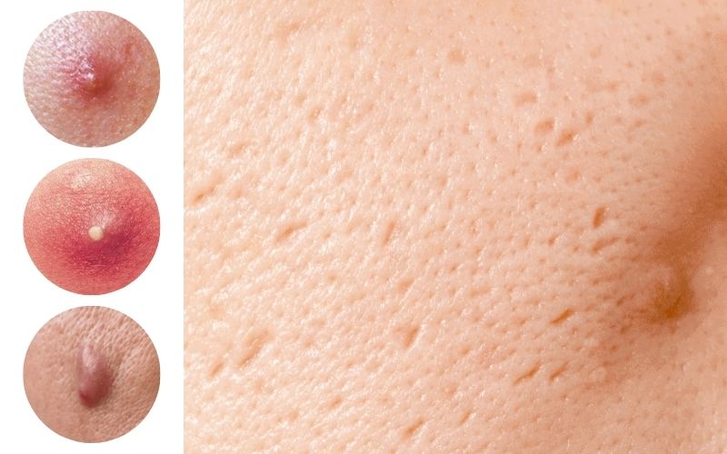 Mụn viêm kéo dài có thể để lại sẹo rỗ dù bạn không sờ hay nặn mụn