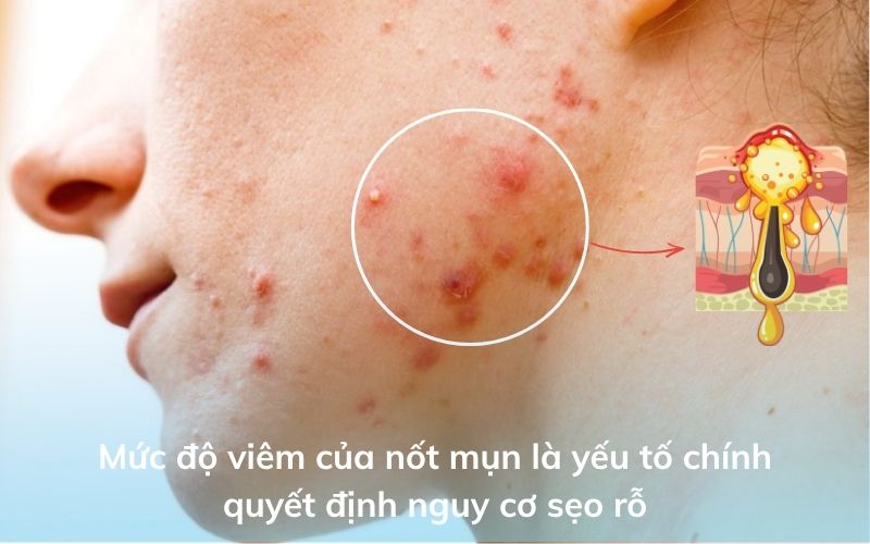 Mức độ viêm của nốt mụn là yếu tố chính quyết định nguy cơ sẹo rỗ