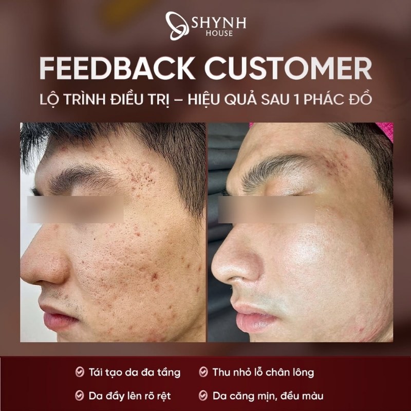 NEW PERFECT SKIN PREMIUM - Phác đồ điều trị sẹo rỗ cá nhân hóa chuẩn y khoa