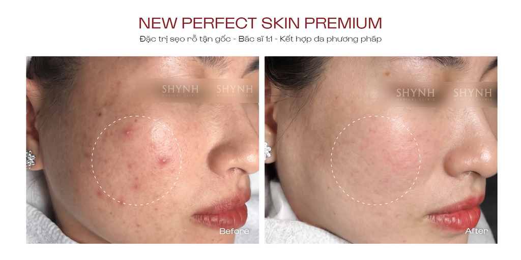 Hình ảnh tình trạng da trước và sau liệu trình New Perfect Skin Premium tại Shynh Medical Clinic
