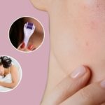 10 Cách phục hồi da mặt bị rỗ tại nhà cấp tốc