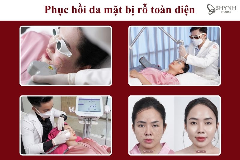 Shynh House đồng hành cùng khách hàng trong phục hồi da mặt bị rỗ toàn diện