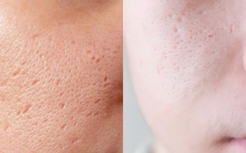 Sẹo đáy nhọn là dạng sẹo rỗ có miệng hẹp nhưng ăn sâu vào da