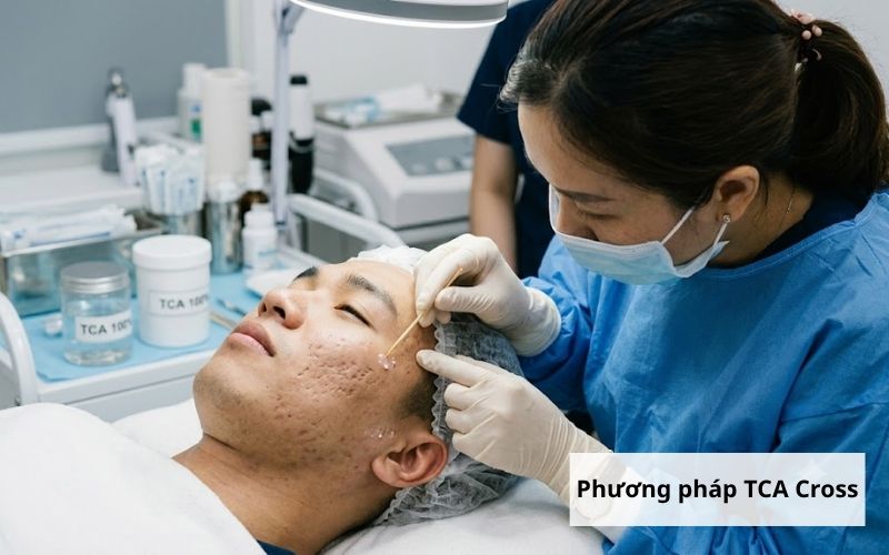TCA Cross - phương pháp vàng cho sẹo đáy nhọn