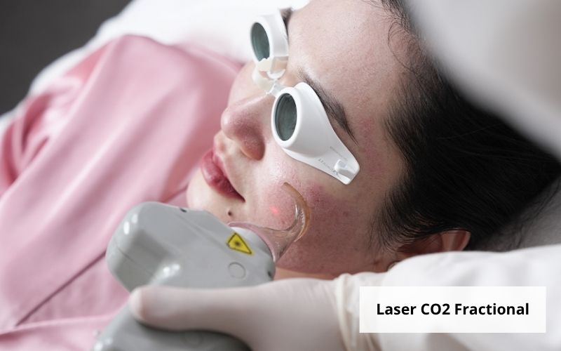 Laser CO2 Fractional tạo các vi tổn thương để kích thích tái tạo collagen