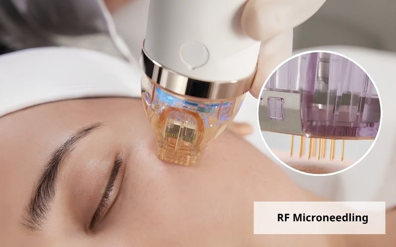 RF Microneedling sử dụng các đầu kim siêu nhỏ đưa năng lượng vào bên trong da