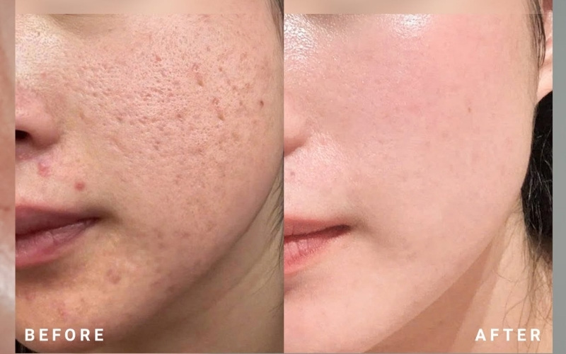 Sẹo đáy nhọn và lỗ chân lông to khác nhau như thế nào?