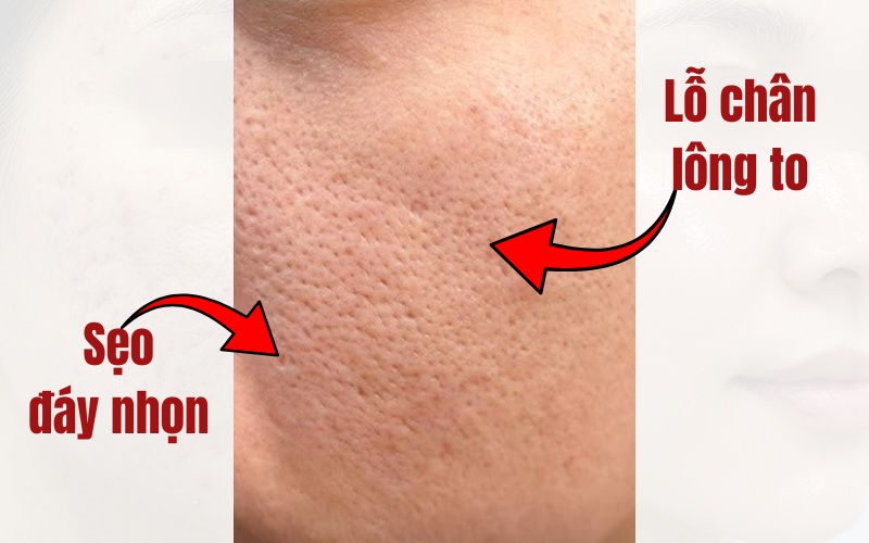 Sẹo rỗ là những vùng da lõm xuống với kích thước, hình dạng không đồng nhất