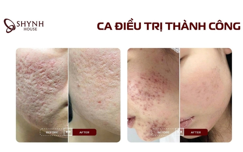 Shynh House - Chẩn đoán và điều trị đúng loại sẹo từ lần đầu