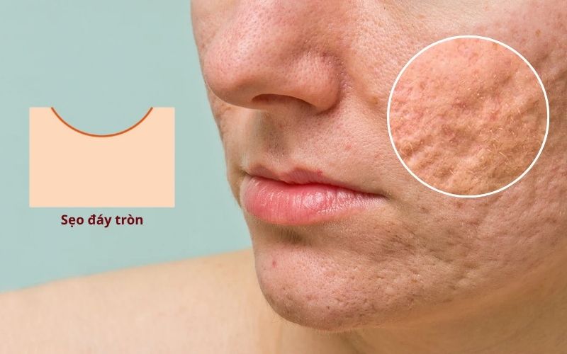 Sẹo đáy tròn là một dạng sẹo rỗ khá phổ biến