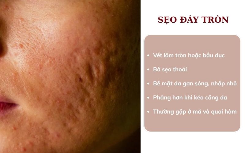 Dấu hiệu nhận biết sẹo đáy tròn