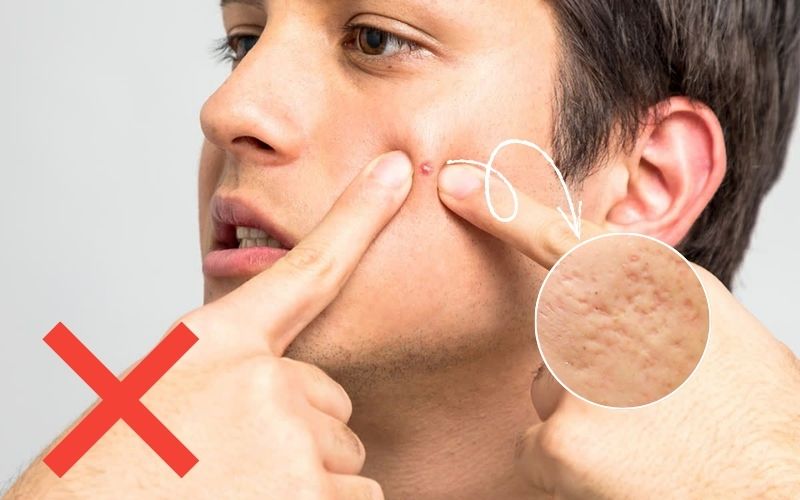 Tự nặn hoặc chích mụn sai cách làm tăng nguy cơ hình thành sẹo