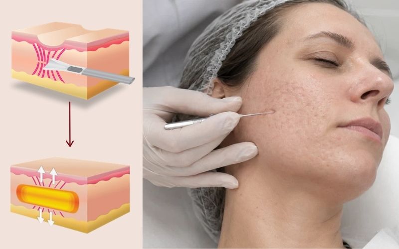Subcision sử dụng kim chuyên dụng để bóc tách chân sẹo